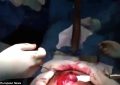 LIVE Fish Removed from Man's Intestine