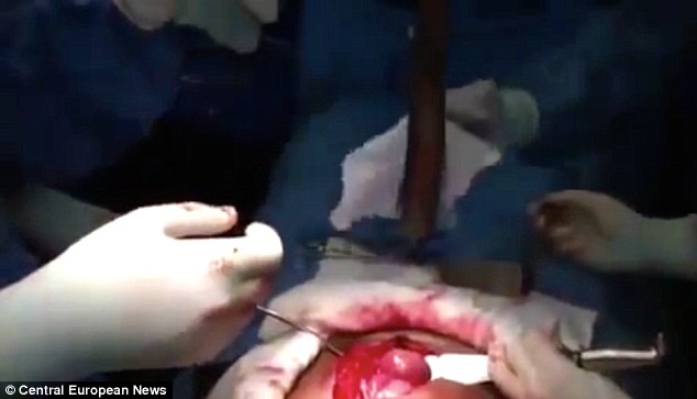 LIVE Fish Removed from Man's Intestine