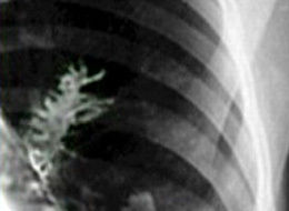 FIR tree inside man's lung