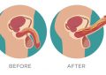 Erectile Dysfunction New Treatment and Prevention
