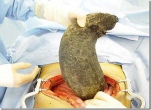 10 Pound Hairball in Woman Stomach