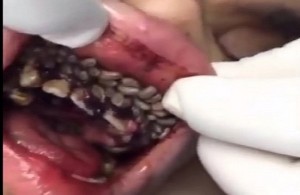 Worst things Dentist finds in patient mouth
