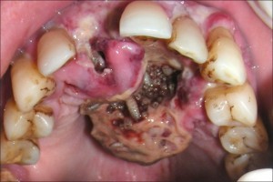 Dentist finds maggots in patient mouth