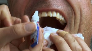 Dentist finds Glue in patient mouth 