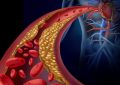 Arteriosclerosis Treatment and Prevention