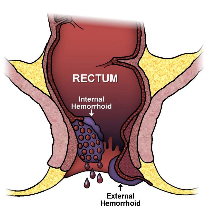 Hemorrhoids Treatment and Prevention