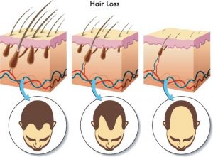 Simplest hair loss treatment and prevention ever!