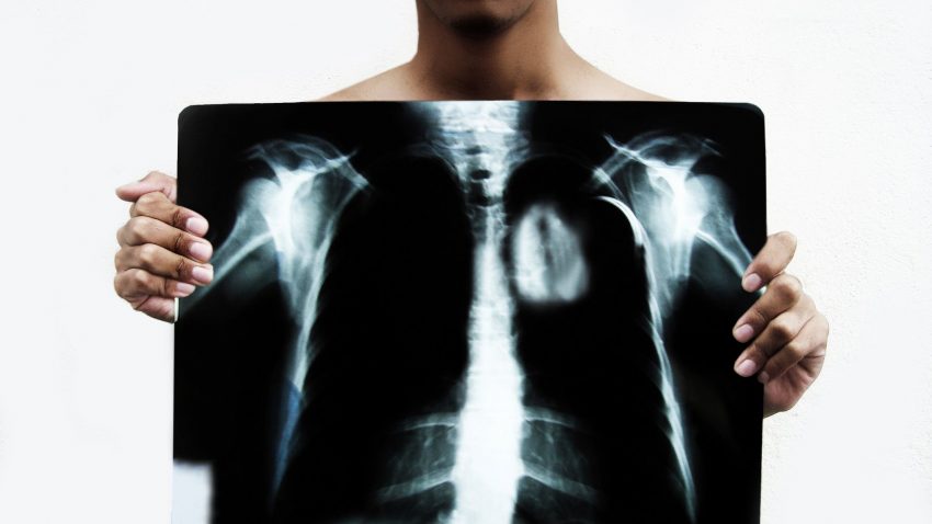 Angina Causes, Symptoms and Treatment