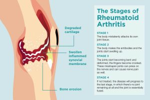 Rheumatism Treatment, Prevention, Diet
