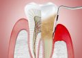 Periodontitis Causes, Treatment and Prevention