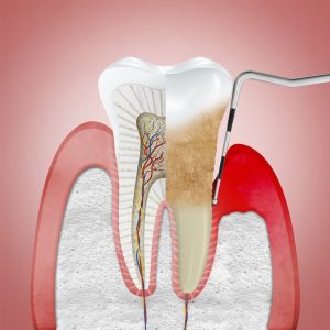 Periodontitis Causes, Treatment and Prevention