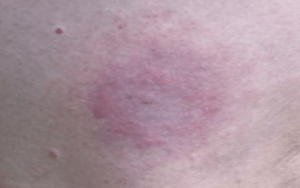 lyme disease