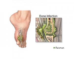 Osteomyelitis, bone infection