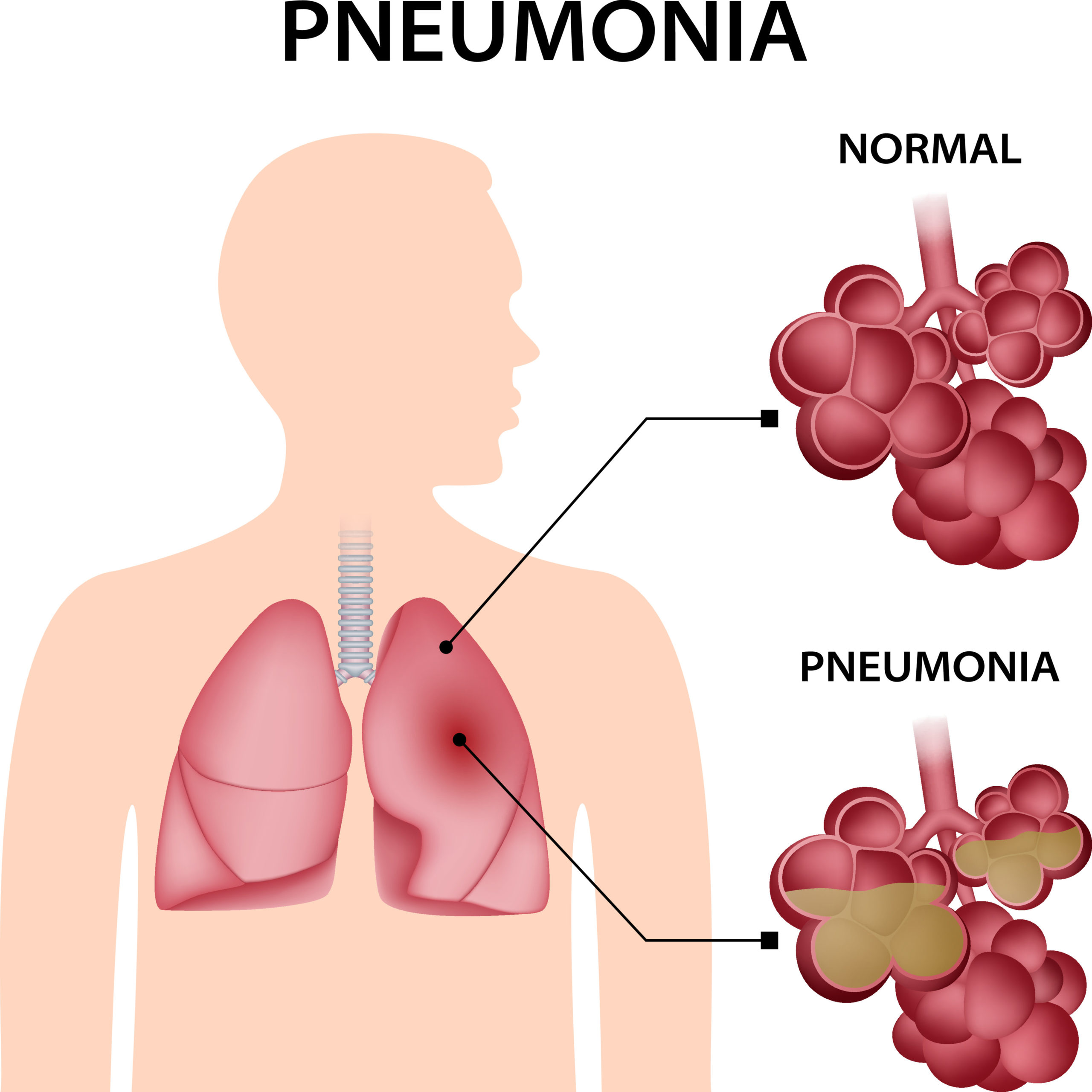 pneumonia-concept-background-realistic-illustration-of-pneumonia