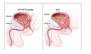 Prostate, prostate disorders