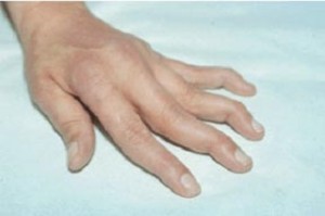 Rheumatism, rheumatic disorder