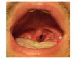 Strep Throat Infection