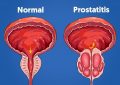 Prostatitis Causes, Symptoms, Treatment, Prevention