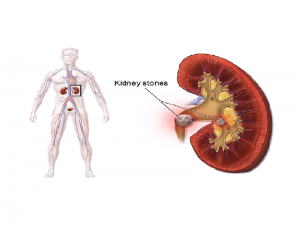 kidney stone treatment