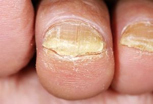 Nail Fungus Treatment, Prevention and More
