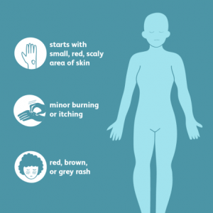 Ringworm Treatment, symptoms, Prevention