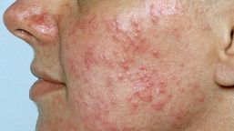 Acne Rosacea Treatment, Prevention and Diet