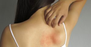 Skin Infection Treatment and Prevention