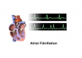 Atrial Fibrillation