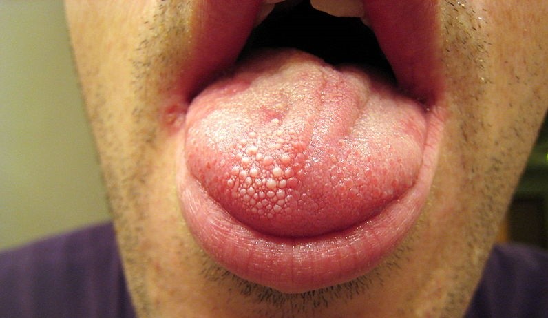 dry mouth, dry mouth treatment