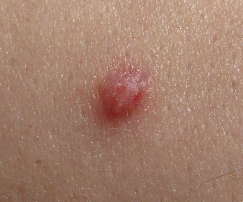 genital warts