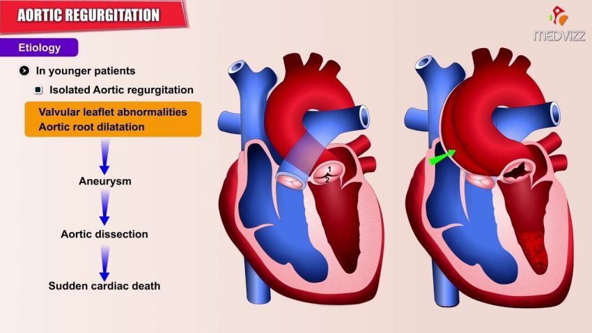 Aortic Insufficiency Symptoms, Treatment, Prevention - Booboone.com