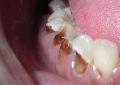 tooth decay - dental caries