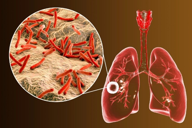 New Tuberculosis Treatment and Prevention
