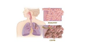 COPD, COPD Treatment