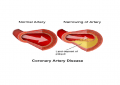 Coronary Heart Disease, coronary artery disease