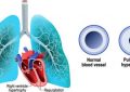 Pulmonary Hypertension Treatment and Prevention