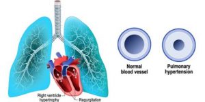 Pulmonary Hypertension Treatment and Prevention