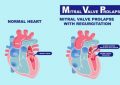 Mitral Valve Prolapse Treatment and Prevention