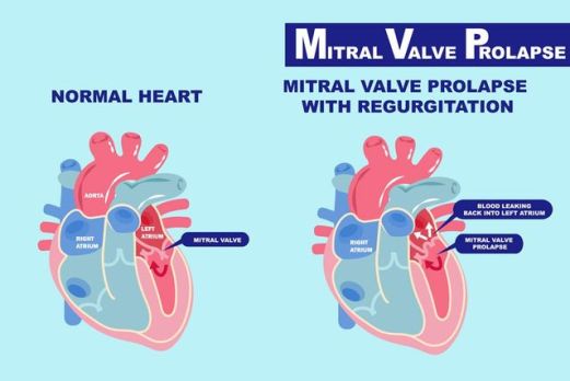 Mitral Valve Prolapse Treatment and Prevention