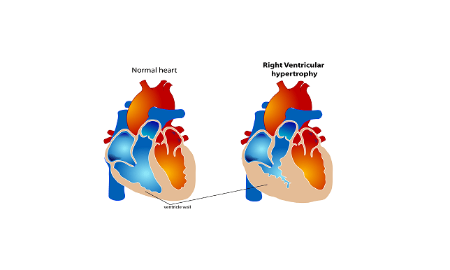 congenital heart defect