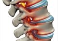 Spinal Stenosis Treatment, Prevention, Diet