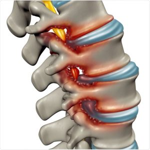 Spinal Stenosis Treatment, Prevention, Diet