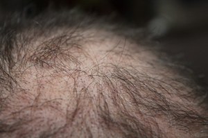 Hair Restoration Products, Costs, and Hair Regrowth Tips