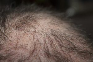 hair restoration 