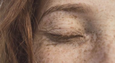 Age Spot Causes, Treatment, Prevention, and Anti Aging Tips