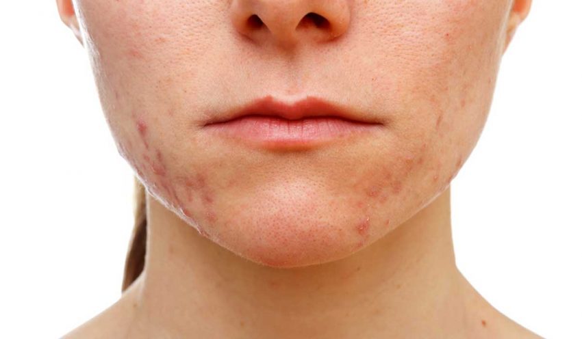 How to Get Rid of Acne Scars Permanently in 15 Days