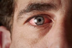 Puffy Eyes and Dark Circles Under Eyes Simple Removal Tips