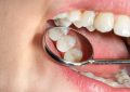 Tooth Filling Cost and Tips to Prevent Dental Caries