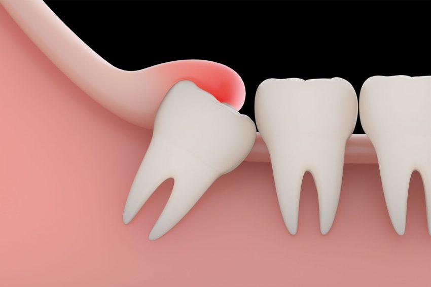 Wisdom Tooth Extraction Infection Prevention and Healing Tips