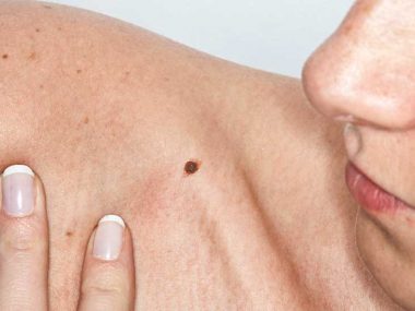 Basal Cell Carcinoma, Symptoms, Treatment, Prevention.